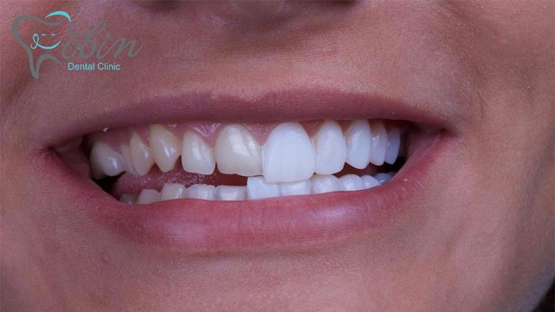 دندان هایی که ناصاف هستند با لمینت به راحتی اصلاح می شوند